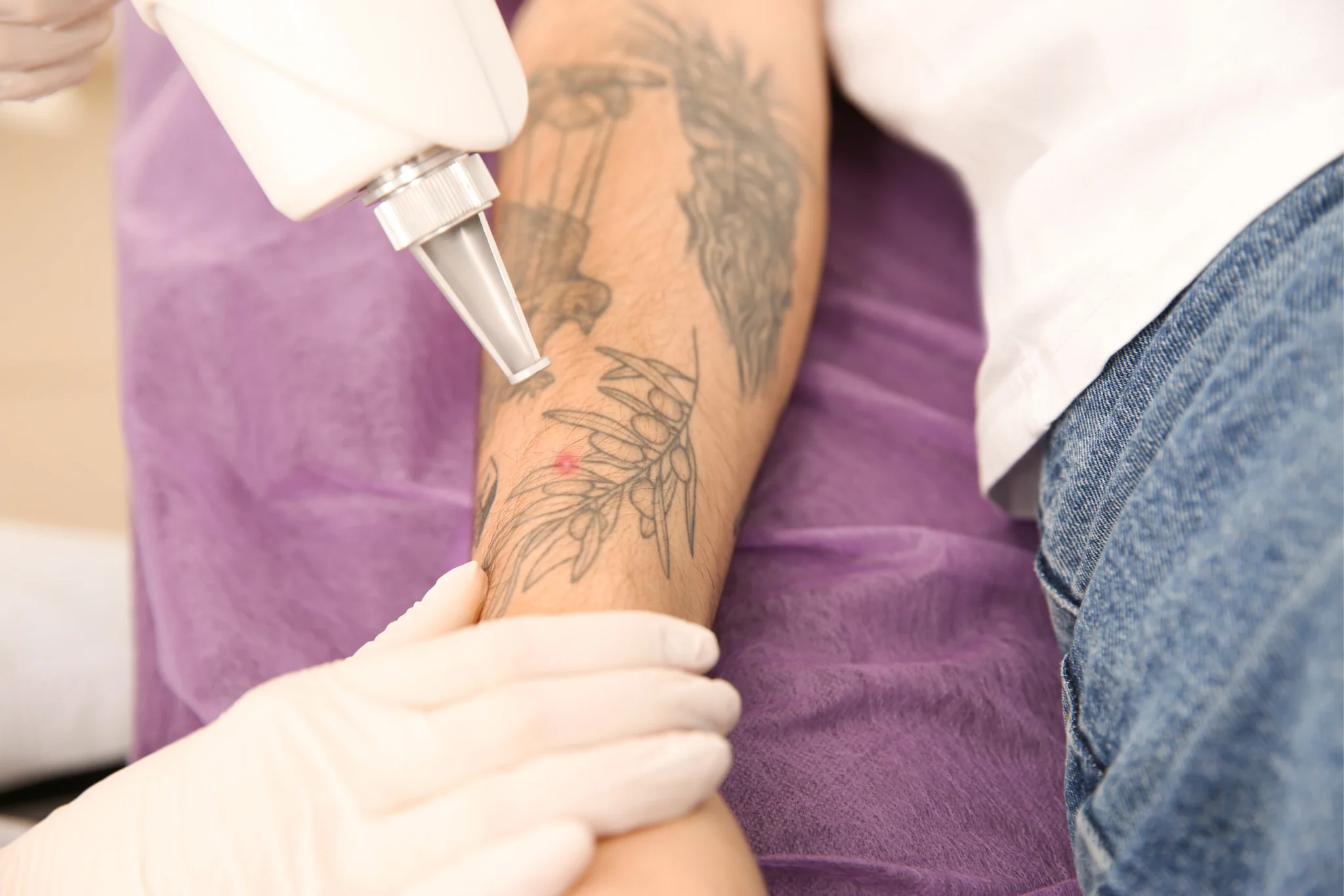 a tattoo is removing from the shoulder with the help of laser machine