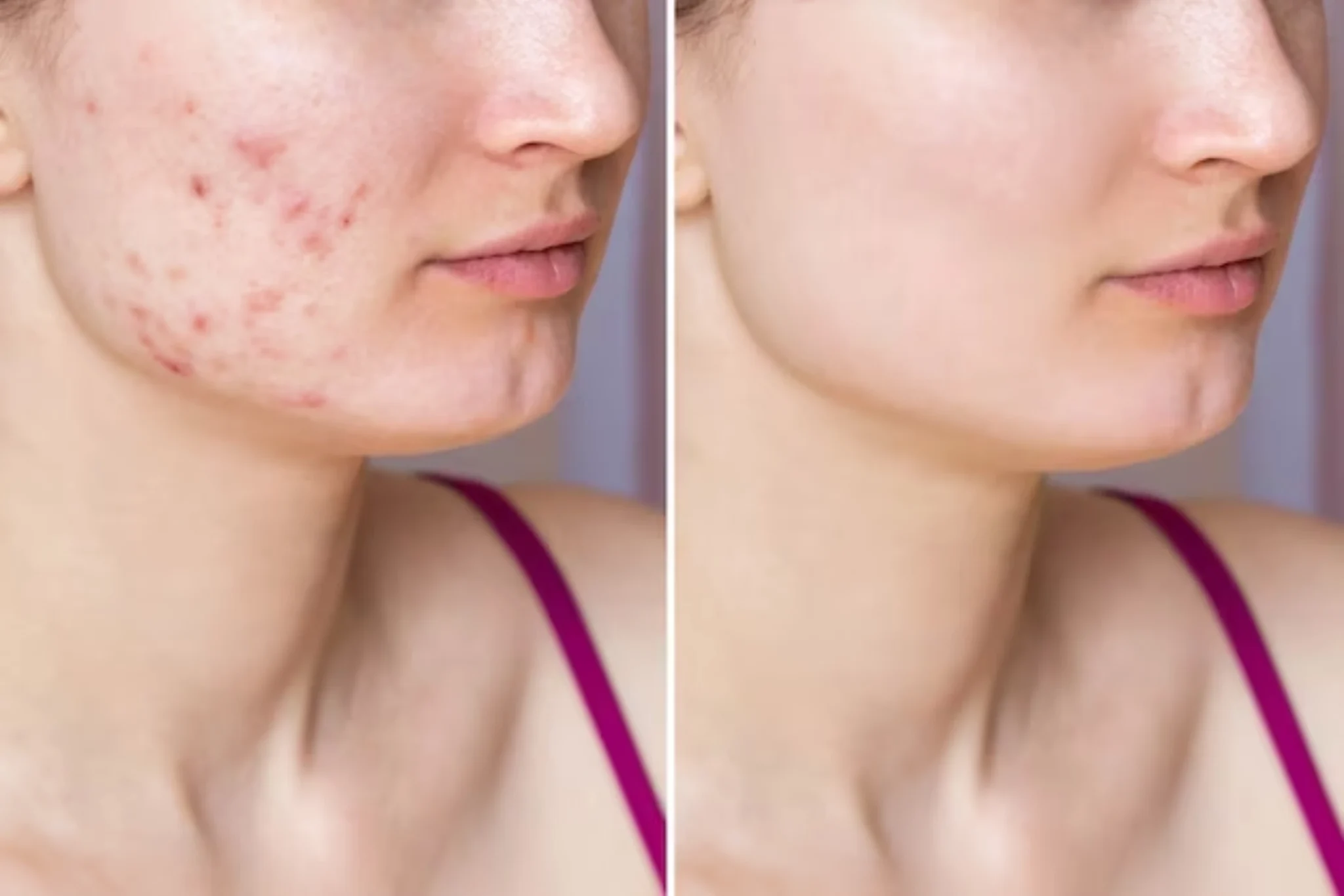 before and after results of pimples treatment