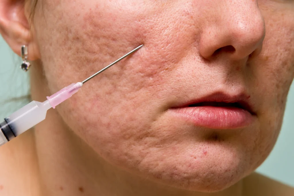 injecting medicine in face to treat acne scars