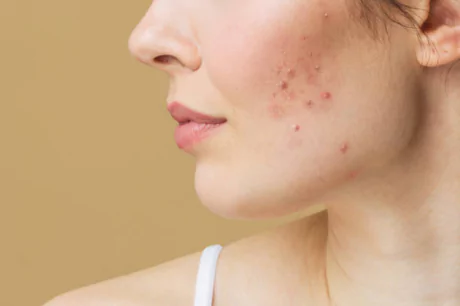Best Pimples Treatment In kashipur
