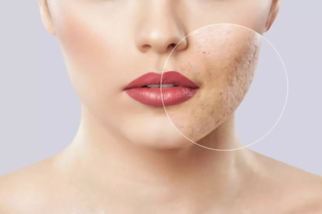 Co2 Laser Treatment for Acne Scars